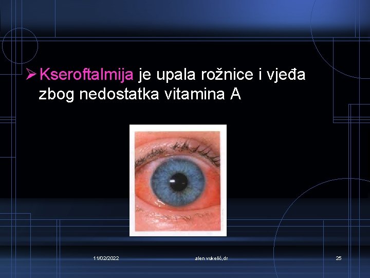 Ø Kseroftalmija je upala rožnice i vjeđa zbog nedostatka vitamina A 11/02/2022 alen vukelić,