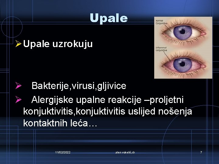 Upale Ø Upale uzrokuju Ø Bakterije, virusi, gljivice Ø Alergijske upalne reakcije –proljetni konjuktivitis,