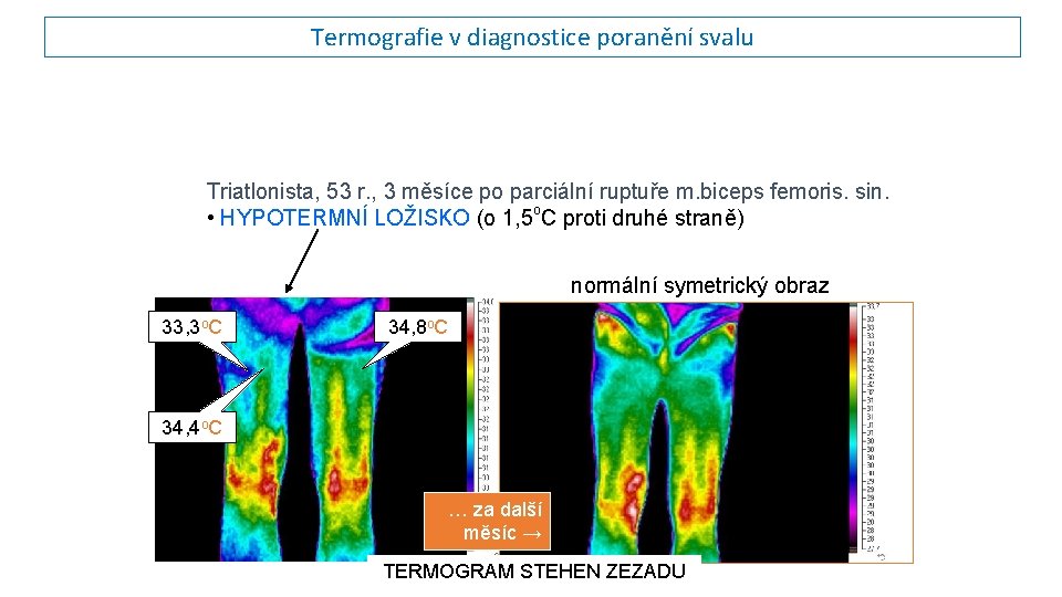 Termografie v diagnostice poranění svalu Triatlonista, 53 r. , 3 měsíce po parciální ruptuře