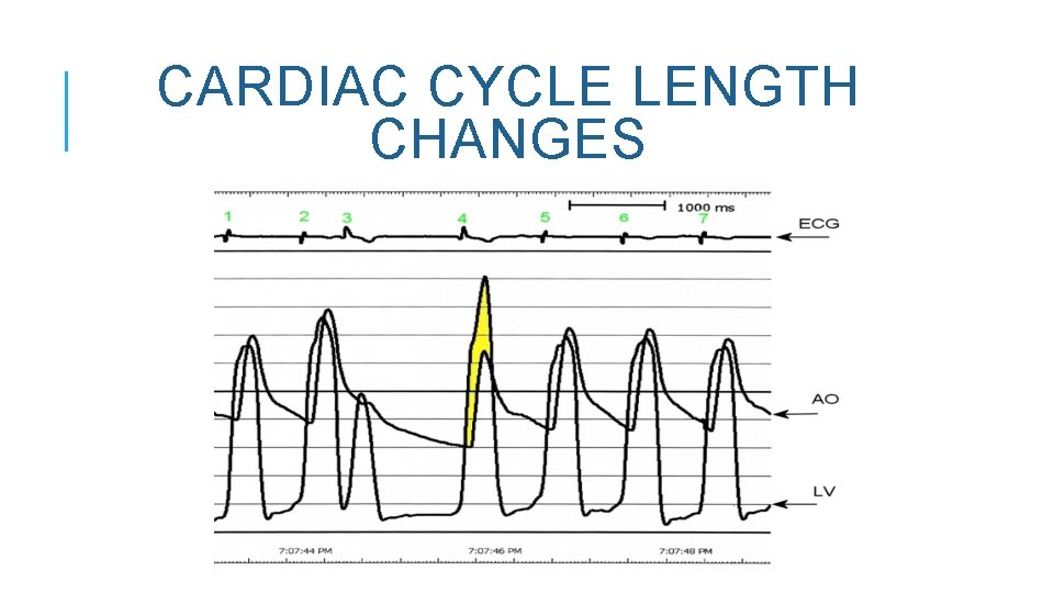 CARDIAC CYCLE LENGTH CHANGES 