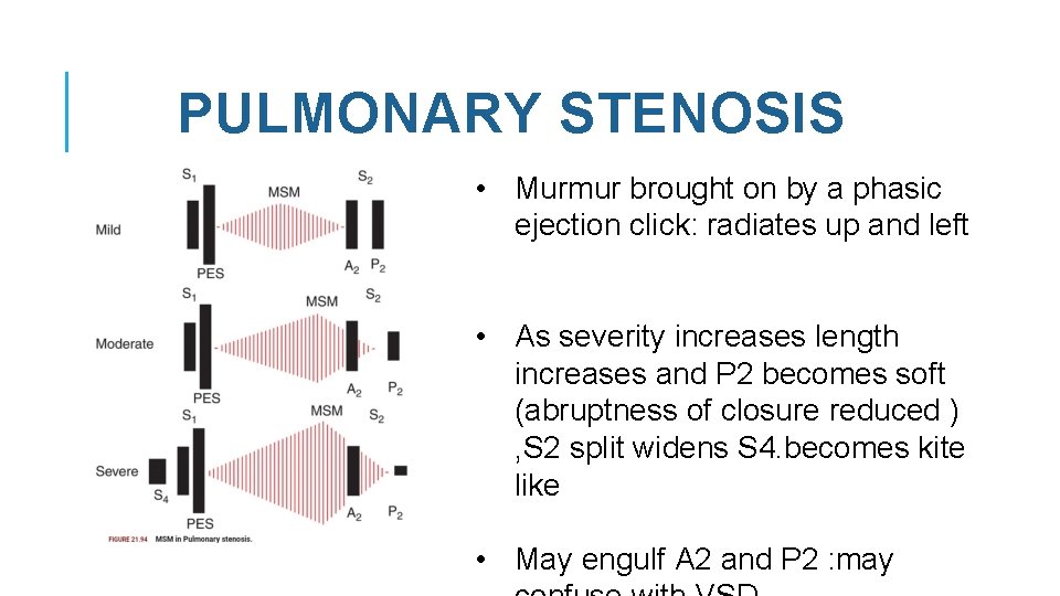 PULMONARY STENOSIS • Murmur brought on by a phasic ejection click: radiates up and