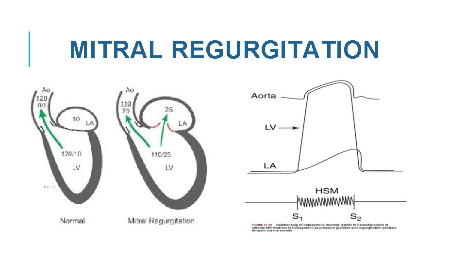 MITRAL REGURGITATION 