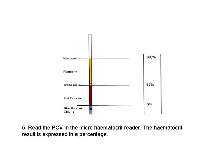 5. Read the PCV in the micro haematocrit reader. The haematocrit result is expressed