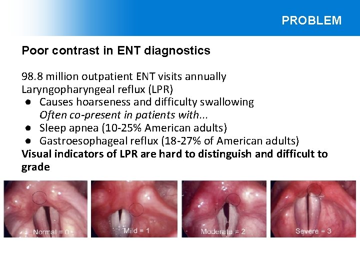 PROBLEM Poor contrast in ENT diagnostics 98. 8 million outpatient ENT visits annually Laryngopharyngeal