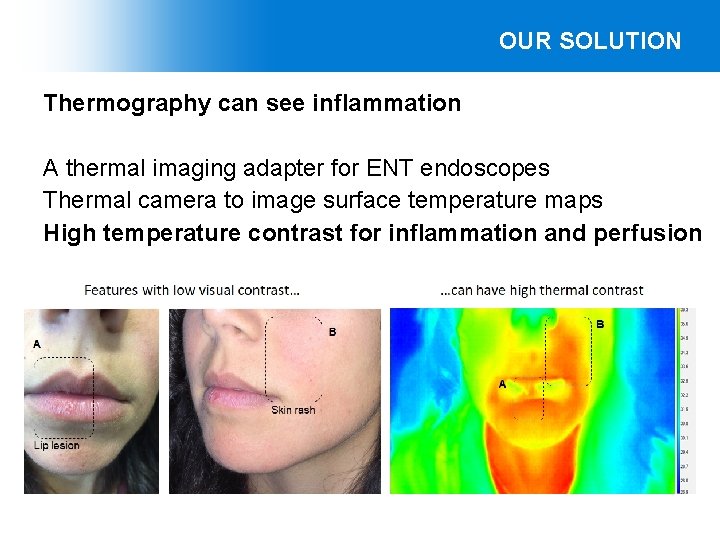 OUR SOLUTION Thermography can see inflammation A thermal imaging adapter for ENT endoscopes Thermal