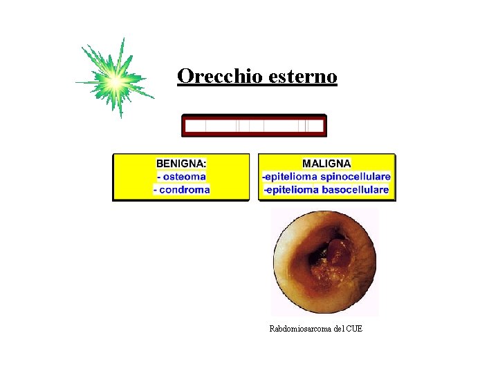 Orecchio esterno Rabdomiosarcoma del CUE 