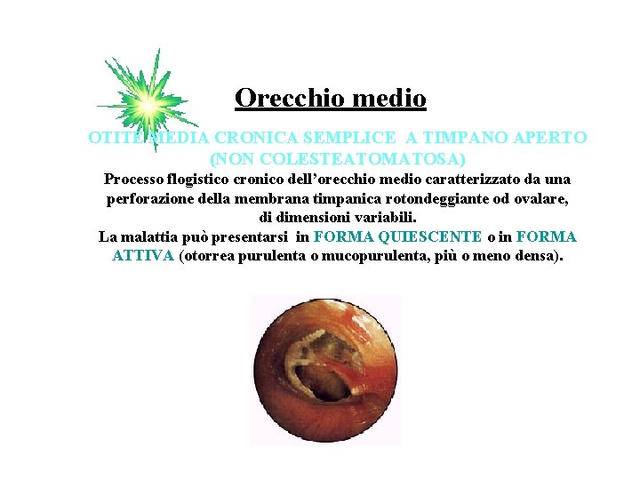 Orecchio medio OTITE MEDIA CRONICA SEMPLICE A TIMPANO APERTO (NON COLESTEATOMATOSA) Processo flogistico cronico