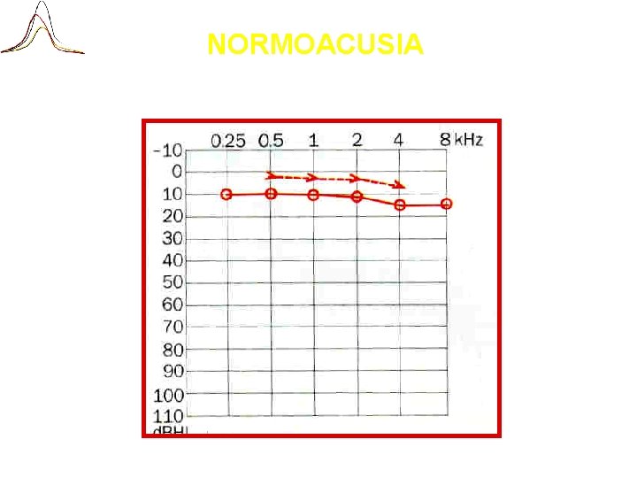 NORMOACUSIA 