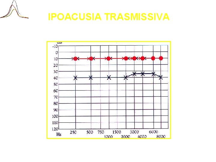 IPOACUSIA TRASMISSIVA 