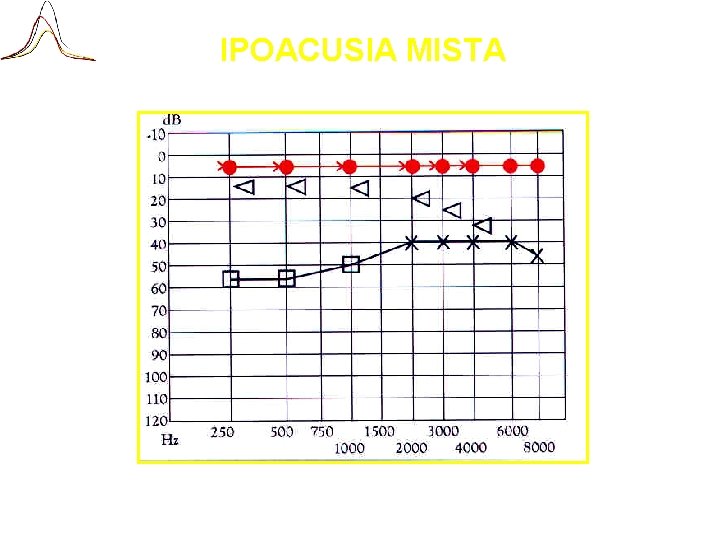 IPOACUSIA MISTA 