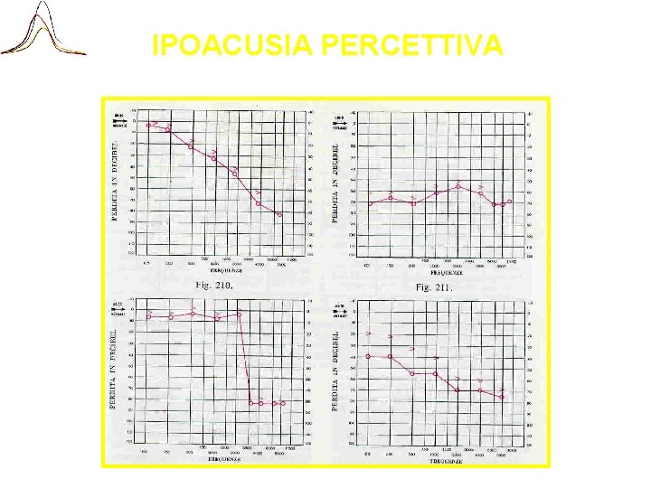 IPOACUSIA PERCETTIVA 