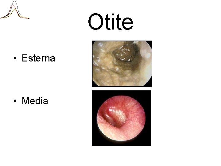 Otite • Esterna • Media 