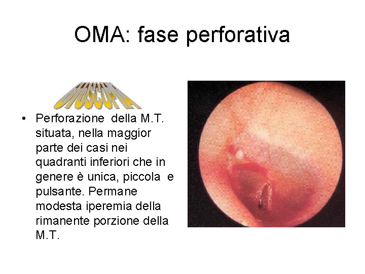 OMA: fase perforativa • Perforazione della M. T. situata, nella maggior parte dei casi