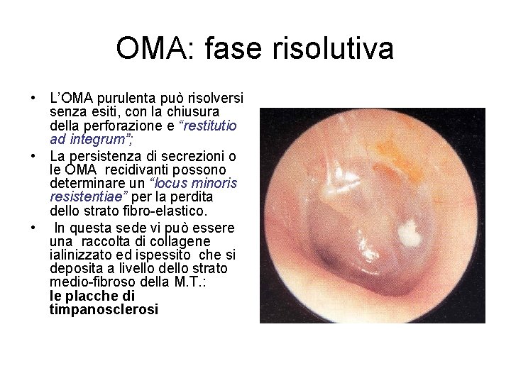 OMA: fase risolutiva • L’OMA purulenta può risolversi senza esiti, con la chiusura della