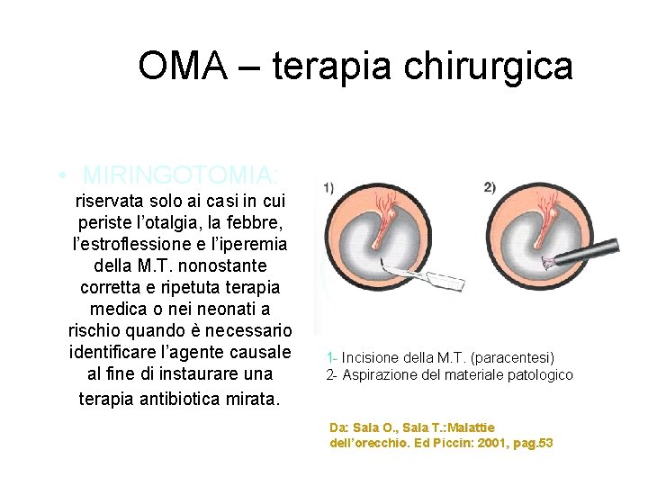 OMA – terapia chirurgica • MIRINGOTOMIA: riservata solo ai casi in cui periste l’otalgia,