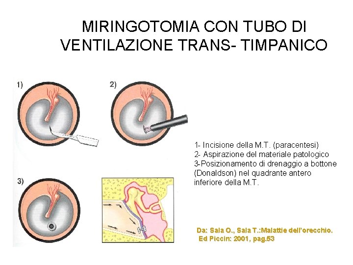 MIRINGOTOMIA CON TUBO DI VENTILAZIONE TRANS- TIMPANICO 1 - Incisione della M. T. (paracentesi)