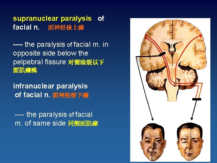 supranuclear paralysis of facial n. 面神经核上瘫 ---- the paralysis of facial m. in opposite
