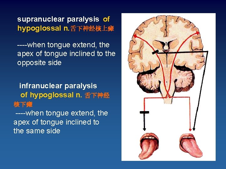 supranuclear paralysis of hypoglossal n. 舌下神经核上瘫 ----when tongue extend, the apex of tongue inclined