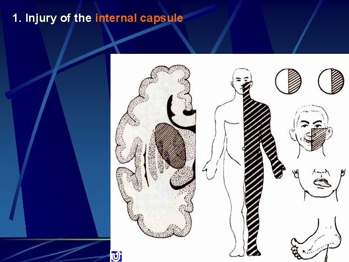 1. Injury of the internal capsule 