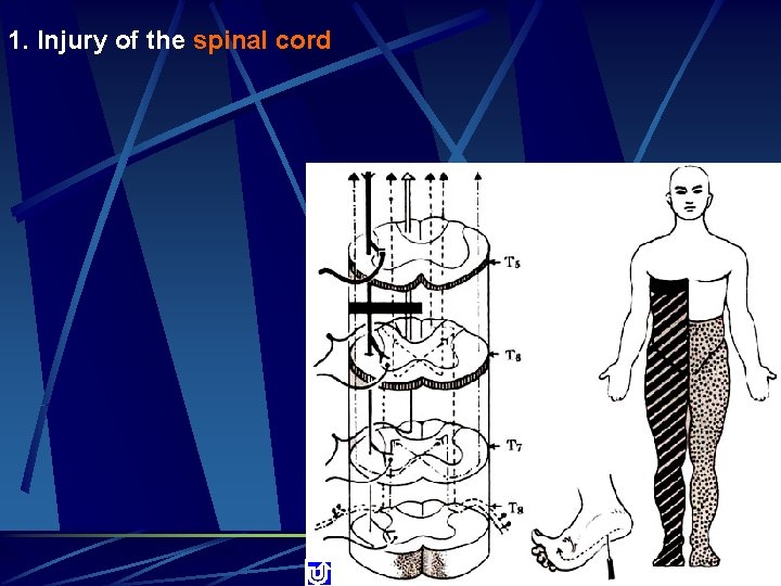 1. Injury of the spinal cord 