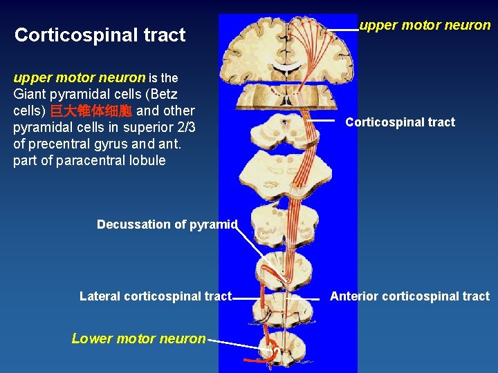 Corticospinal tract upper motor neuron is the Giant pyramidal cells (Betz cells) 巨大锥体细胞 and