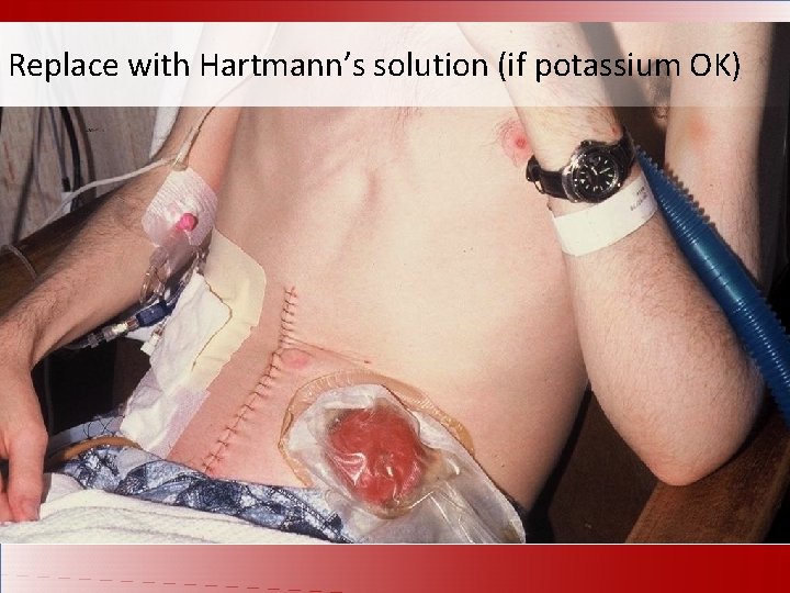 Replace with Hartmann’s solution (if potassium OK) 