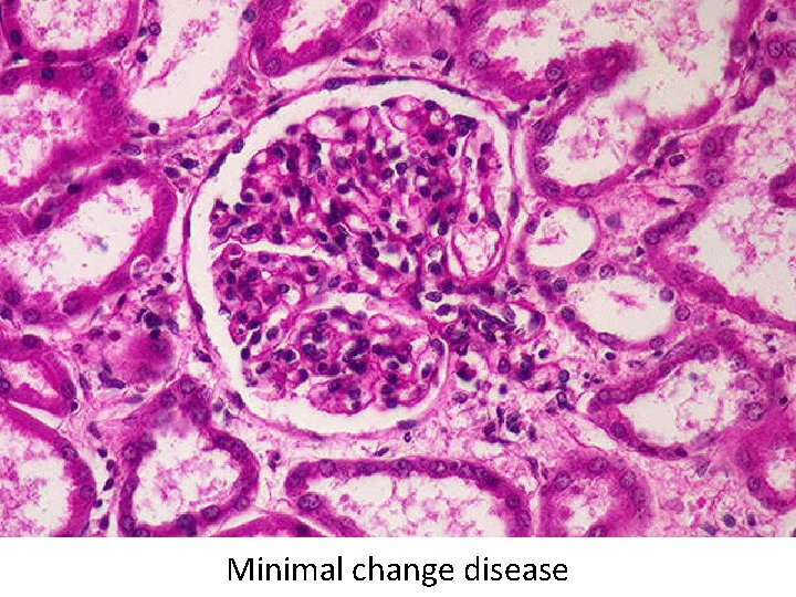 Minimal change disease 