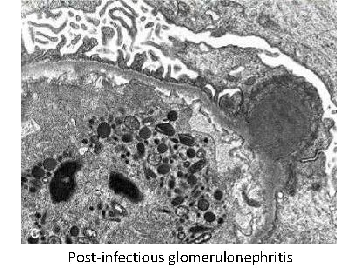 Post-infectious glomerulonephritis 