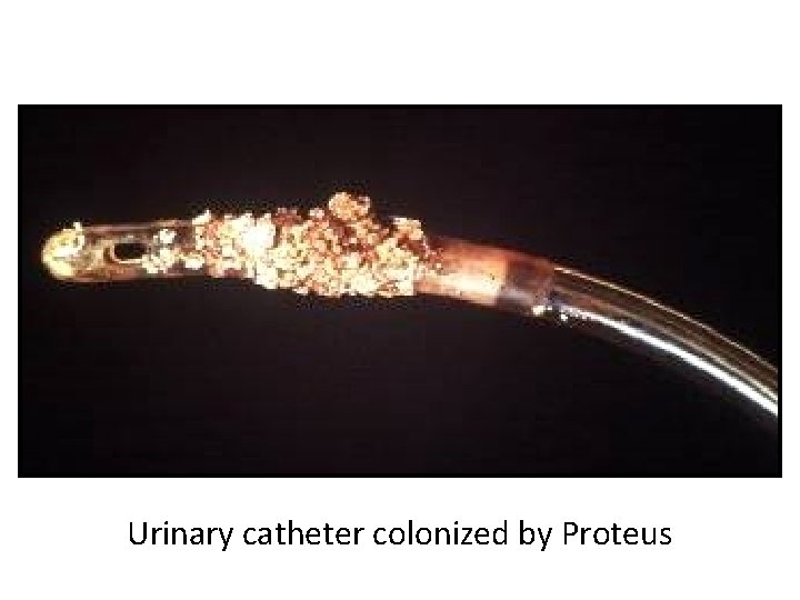 Urinary catheter colonized by Proteus 