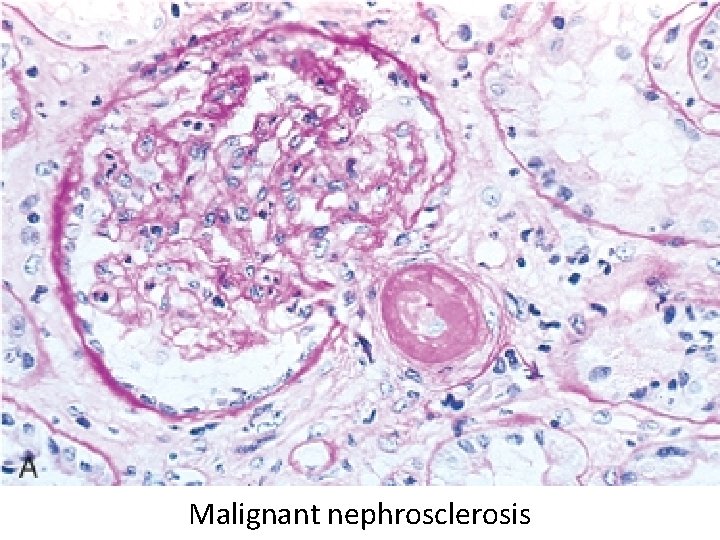 Malignant nephrosclerosis 