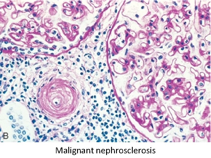 Malignant nephrosclerosis 