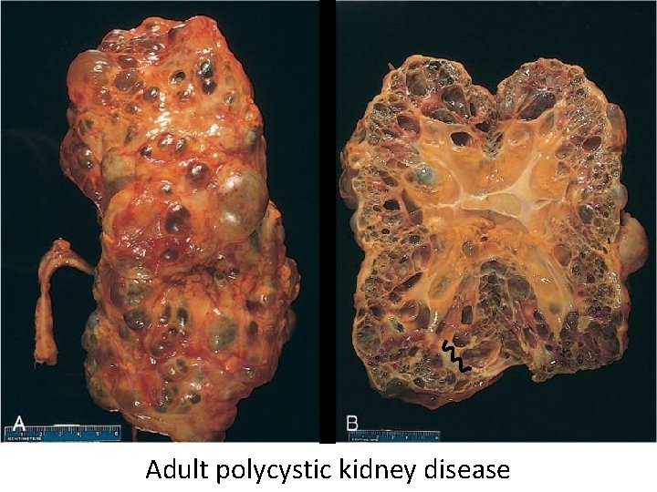 Adult polycystic kidney disease 