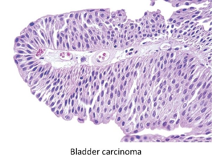 Bladder carcinoma 