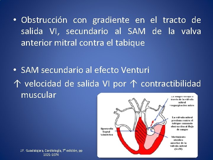  • Obstrucción con gradiente en el tracto de salida VI, secundario al SAM