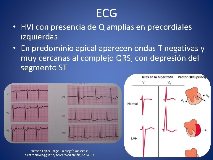 ECG • HVI con presencia de Q amplias en precordiales izquierdas • En predominio