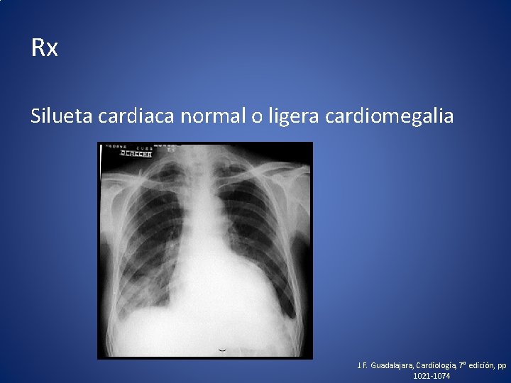 Rx Silueta cardiaca normal o ligera cardiomegalia J. F. Guadalajara, Cardiología, 7° edición, pp