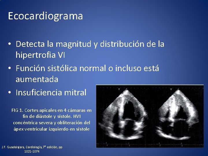 Ecocardiograma • Detecta la magnitud y distribución de la hipertrofia VI • Función sistólica