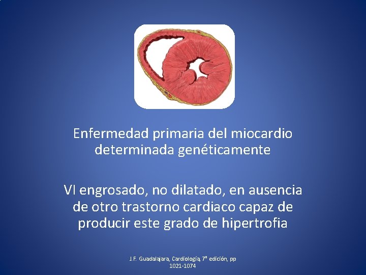 Enfermedad primaria del miocardio determinada genéticamente VI engrosado, no dilatado, en ausencia de otro