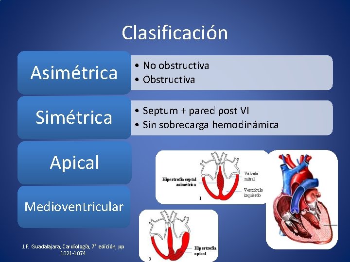 Clasificación Asimétrica Simétrica Apical Medioventricular J. F. Guadalajara, Cardiología, 7° edición, pp 1021 -1074