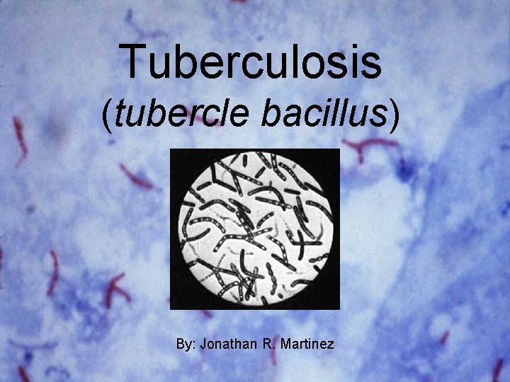 Tuberculosis (tubercle bacillus) By: Jonathan R. Martinez 