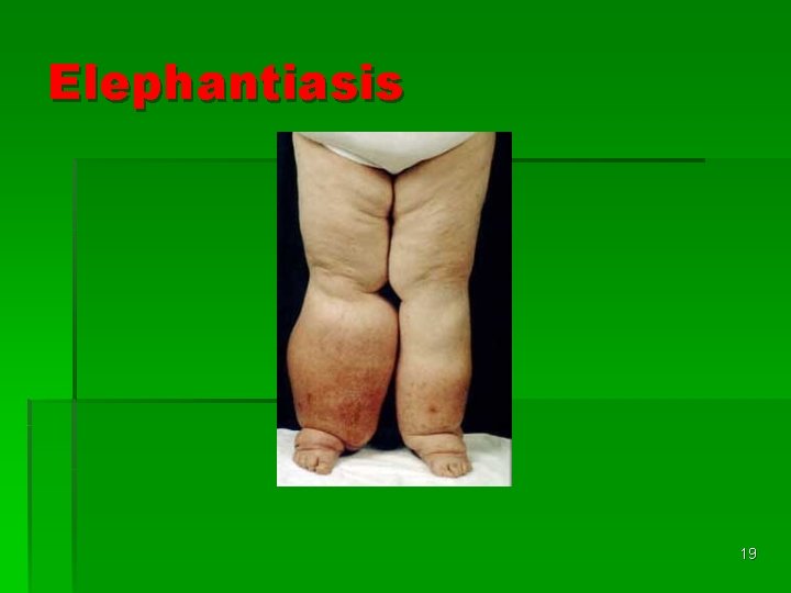 Elephantiasis 19 Elephantiasis 19