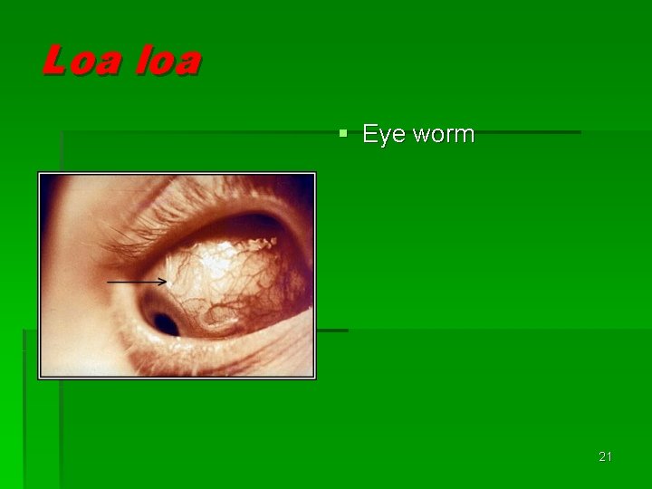Loa loa § Eye worm 21 Loa loa § Eye worm 21