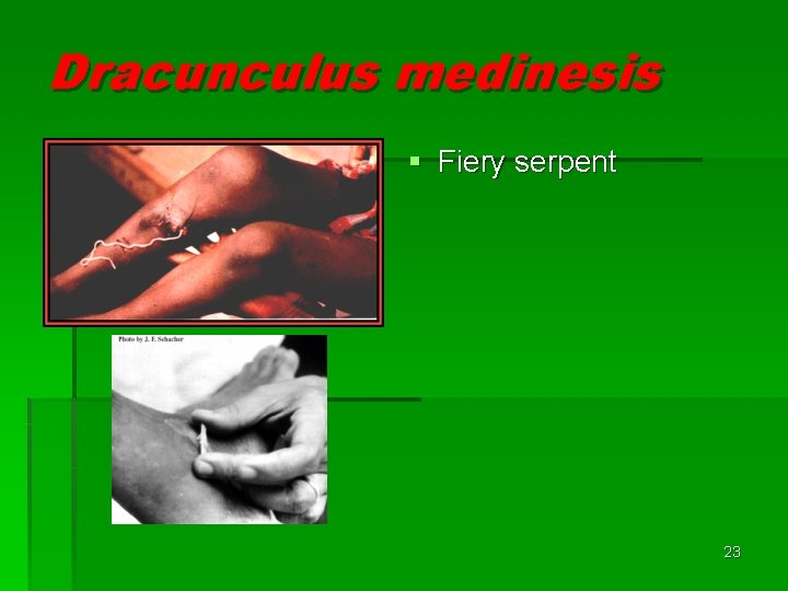 Dracunculus medinesis § Fiery serpent 23 Dracunculus medinesis § Fiery serpent 23