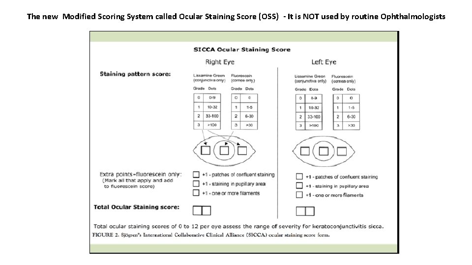 The new Modified Scoring System called Ocular Staining Score (OSS) - It is NOT