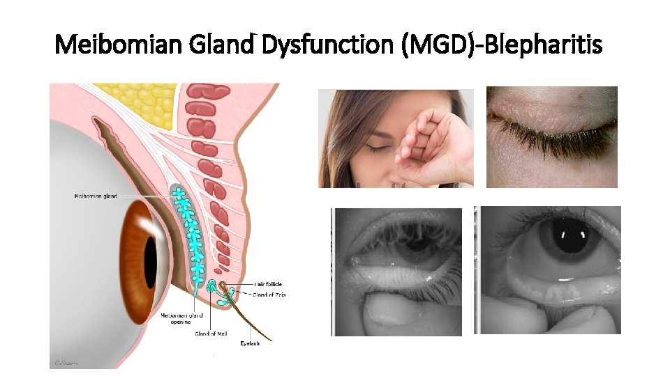 Meibomian Gland Dysfunction (MGD)-Blepharitis 