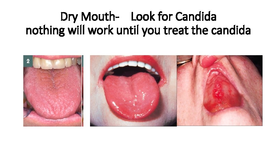 Dry Mouth- Look for Candida nothing will work until you treat the candida 