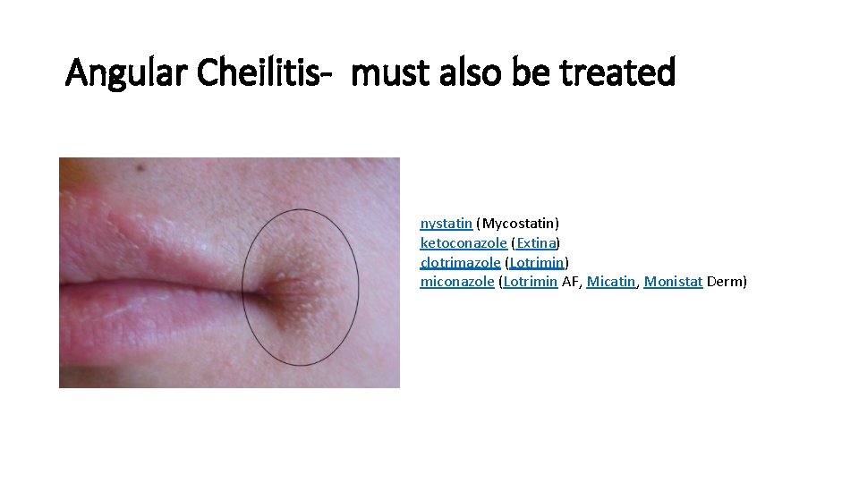 Angular Cheilitis- must also be treated nystatin (Mycostatin) ketoconazole (Extina) clotrimazole (Lotrimin) miconazole (Lotrimin