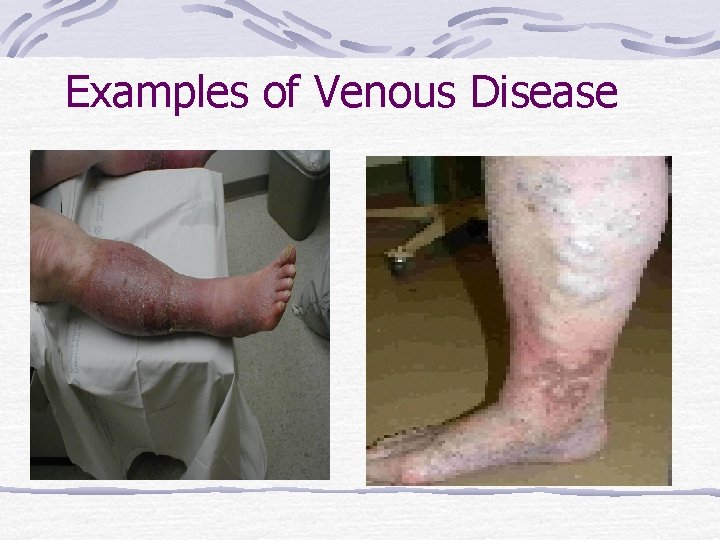 Examples of Venous Disease 