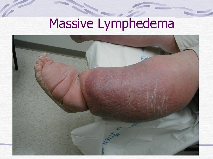 Massive Lymphedema 