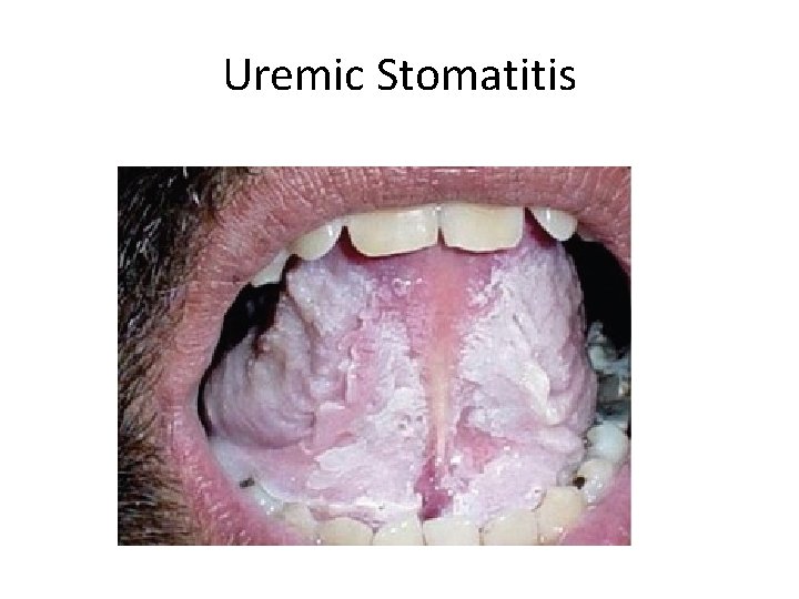 Uremic Stomatitis 